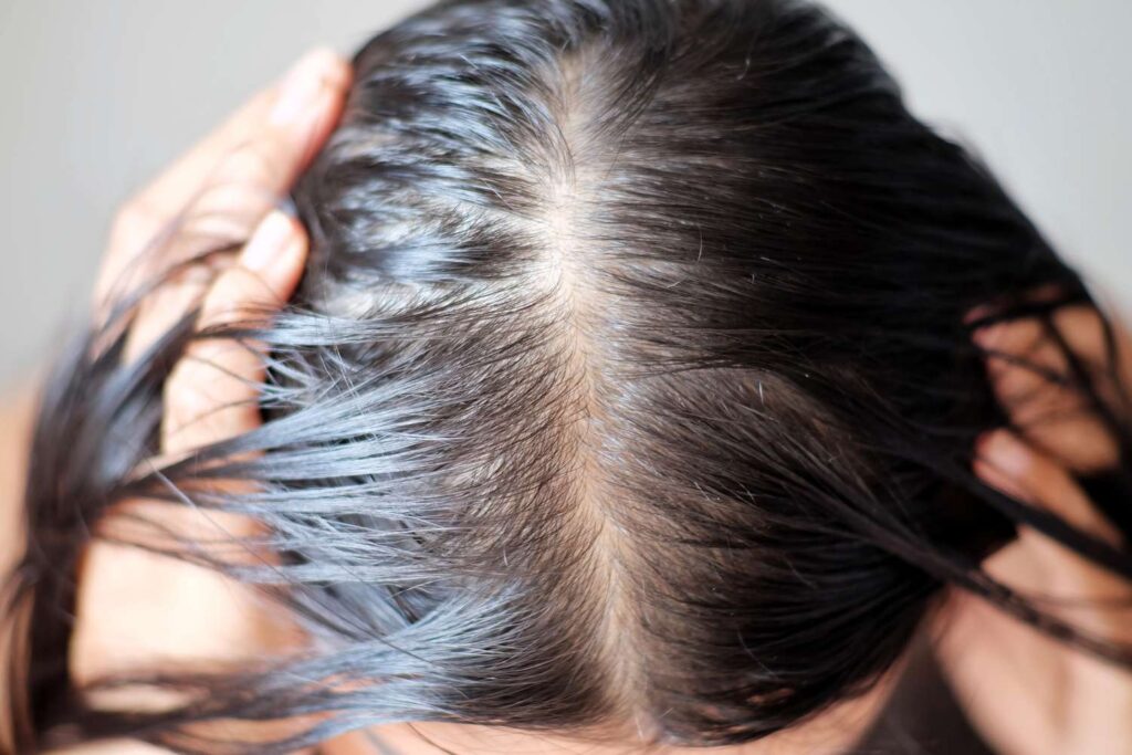 Overview of Hair loss in women and its best treatment