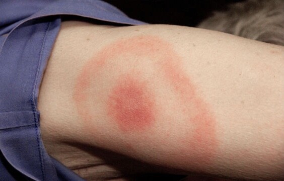 How Do You Test a Person for Mold Exposure