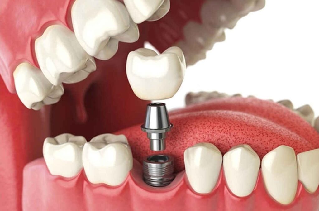 A closer look at the cost, pain, and recovery time of denture implants