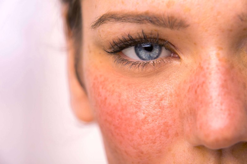 non-surgical rosacea treatments available