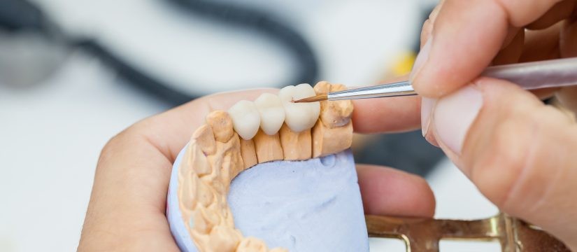 How to Care for Dental Crowns and Bridges: A Comprehensive Guide