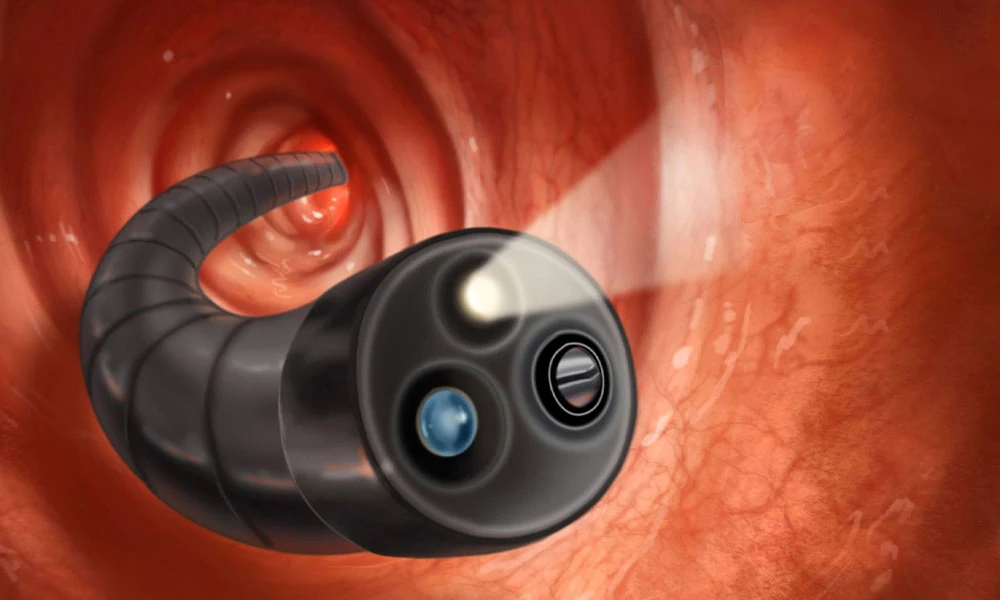 What Affects Colonoscopy Cost in Singapore the Most?