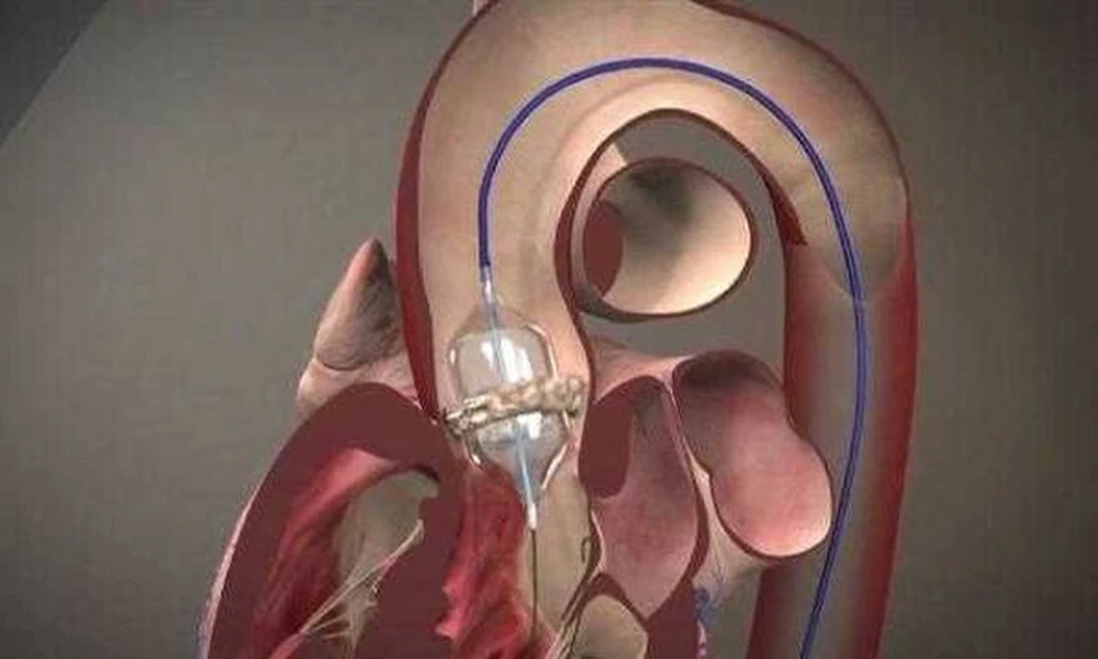 What Makes a Dedicated Heart Valve Clinic Different From General Cardiac Care?