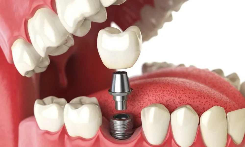 7 Signs You Need a Dental Implant Instead of a Bridge: Guidance From Stubbs Dental and Other Utah Providers